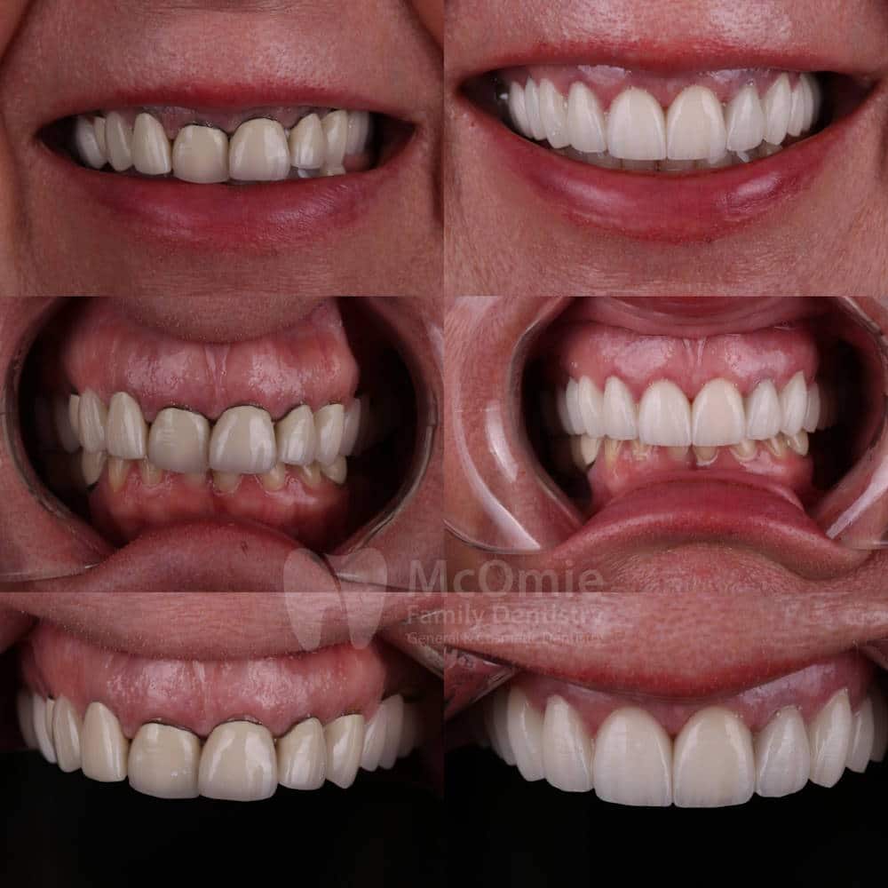 dental bridge work before and after